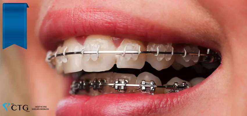 Ortodonti tedavisi